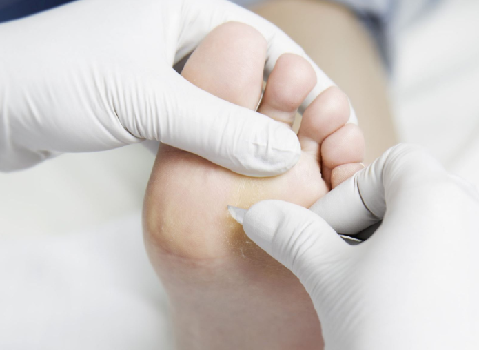 eelt-verwijderen-hijken eelt verwijderen bij pedicure natalie in hijken