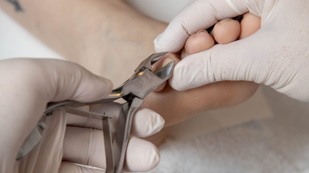 ingegroeide-nagel-behandeling-hijken ingegroeide nagel behandelen in hijken bij pedicure natalie